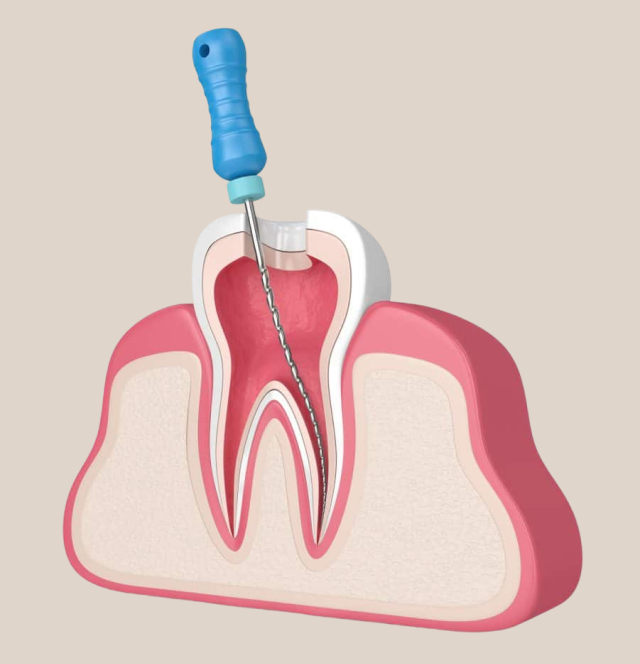 Re-Root Canal